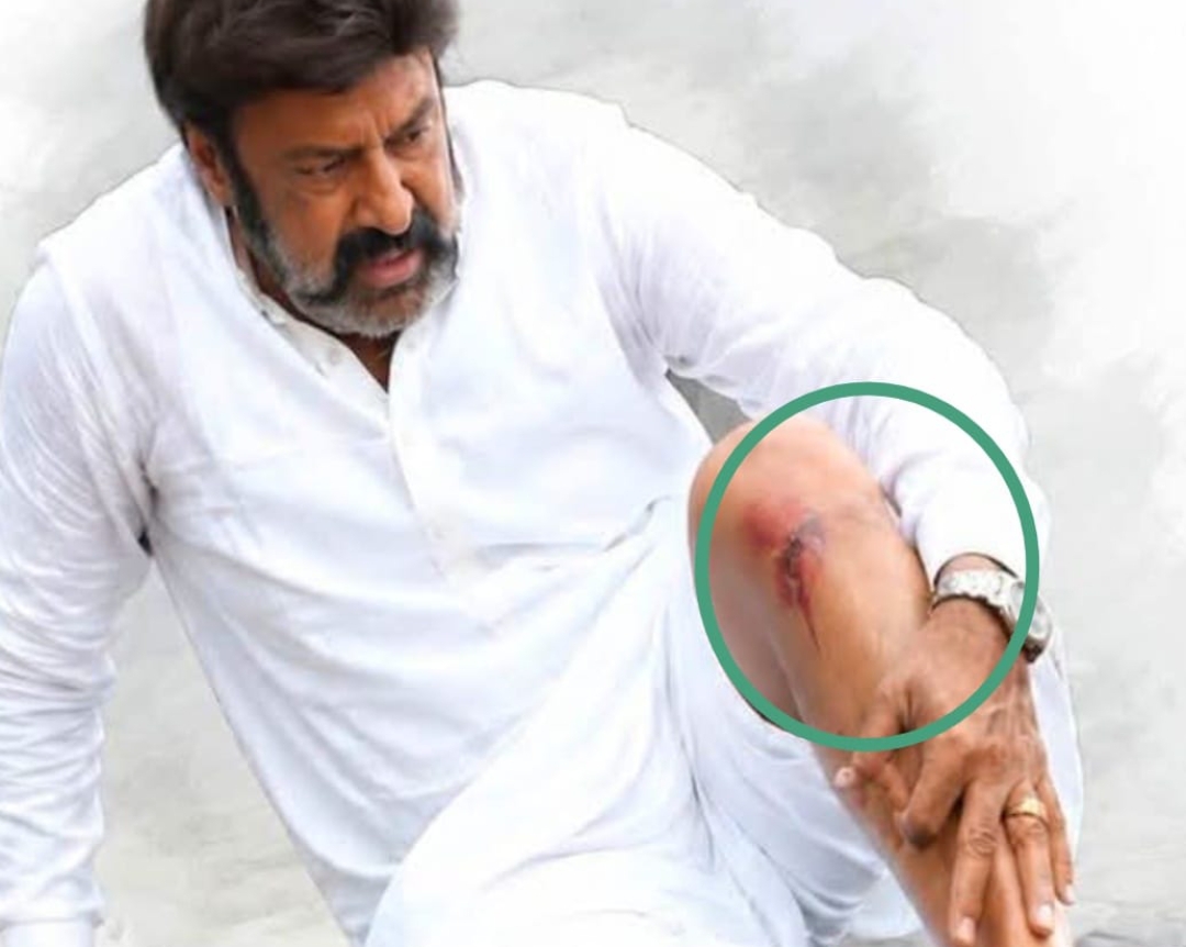 కాకినాడ షూటింగ్&zwnj;లో బాలయ్యకు మజిల్ టేర్... AIGలో చికిత్స