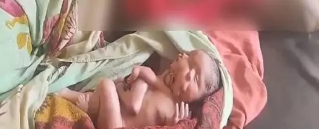 నాలుగు కాళ్లు, నాలుగు చేతులతో శిశువు జననం