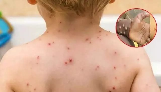 చికెన్ పాక్స్ కొత్త వేరియంట్.. తొలికేసు నమోదు