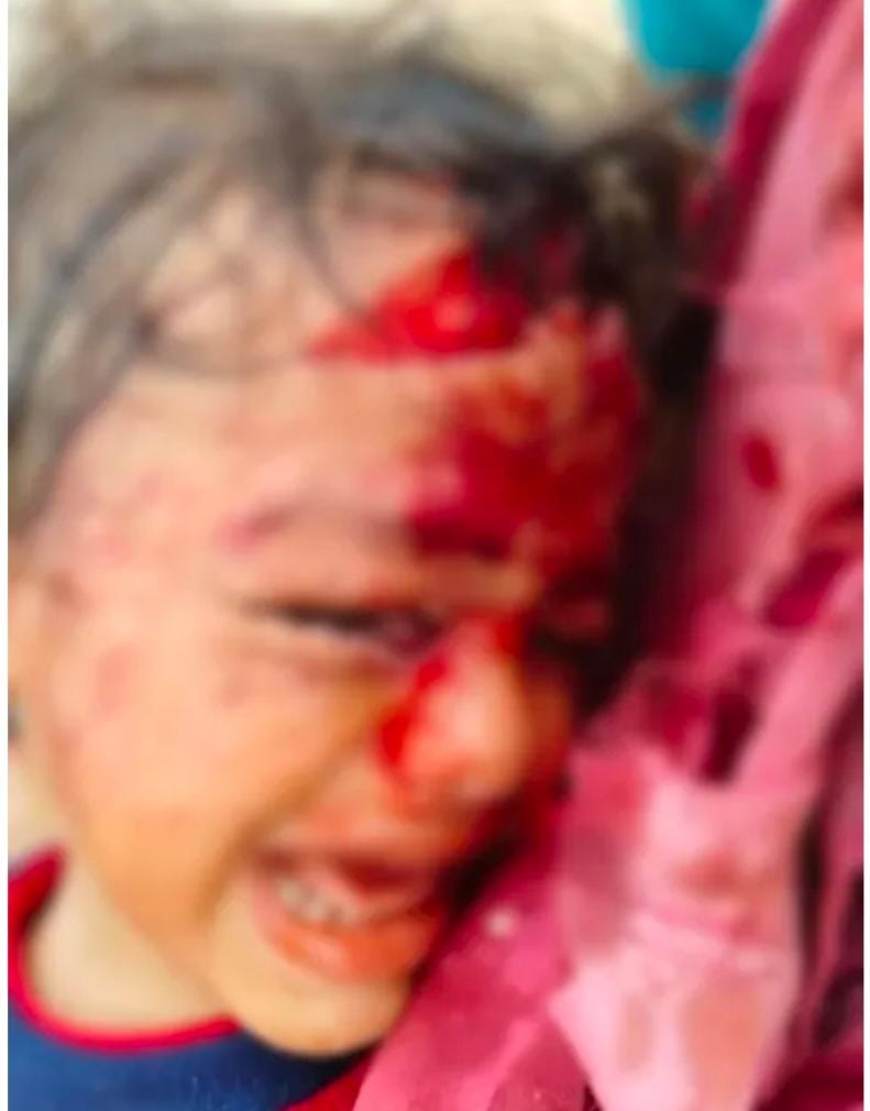 చిన్నారులపై కుక్కల దాడి